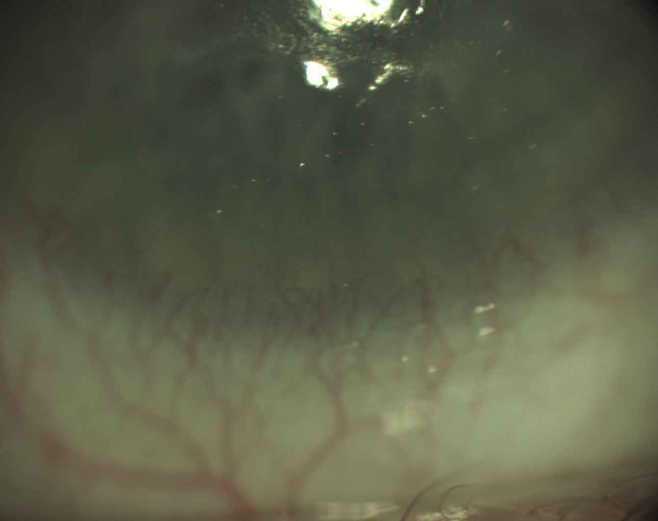 Superior Corneal Staining in Dry Eye